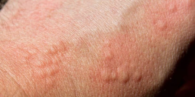 Alergia a Medicamentos