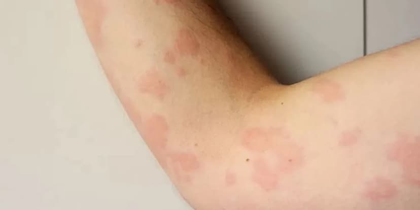 Alergia Alimentaria