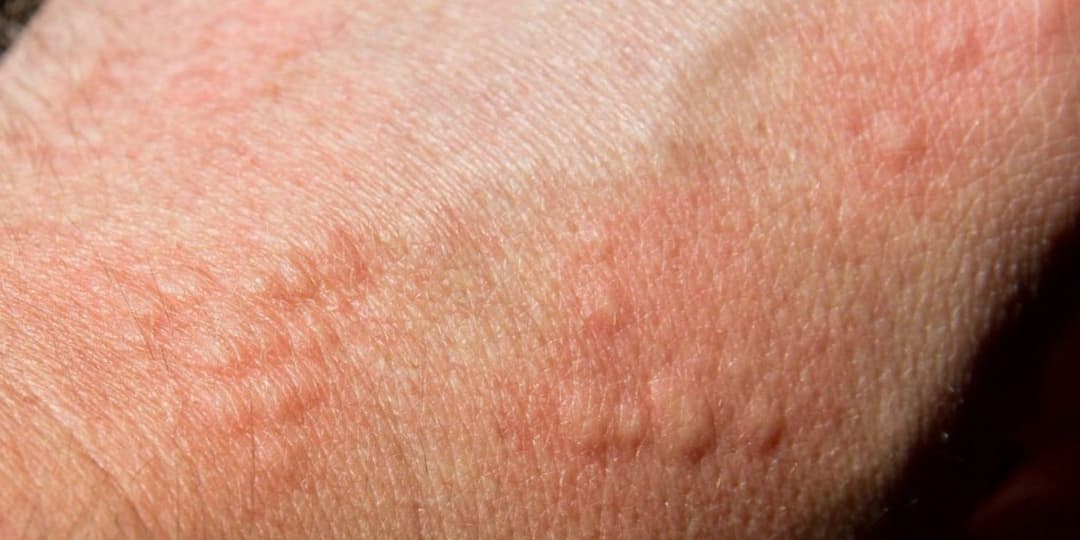 Alergia a Medicamentos