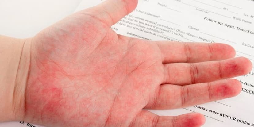 Alergia al Látex