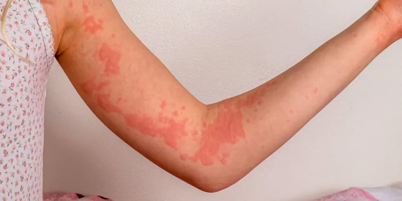 Alergia al Medio de Contraste