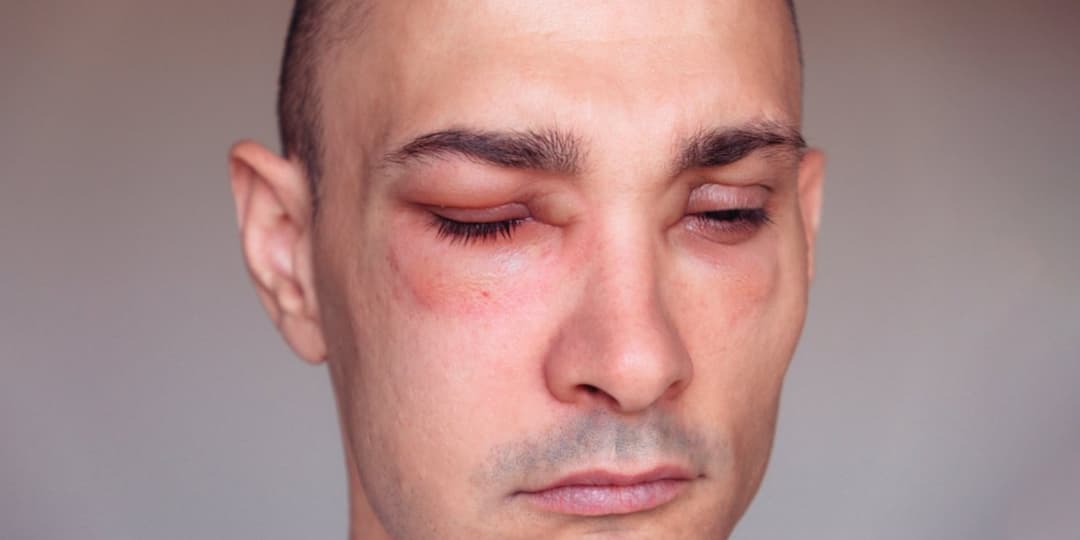 Angioedema