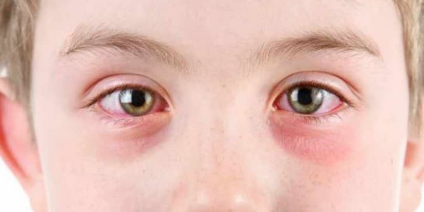 Conjuntivitis Alérgica