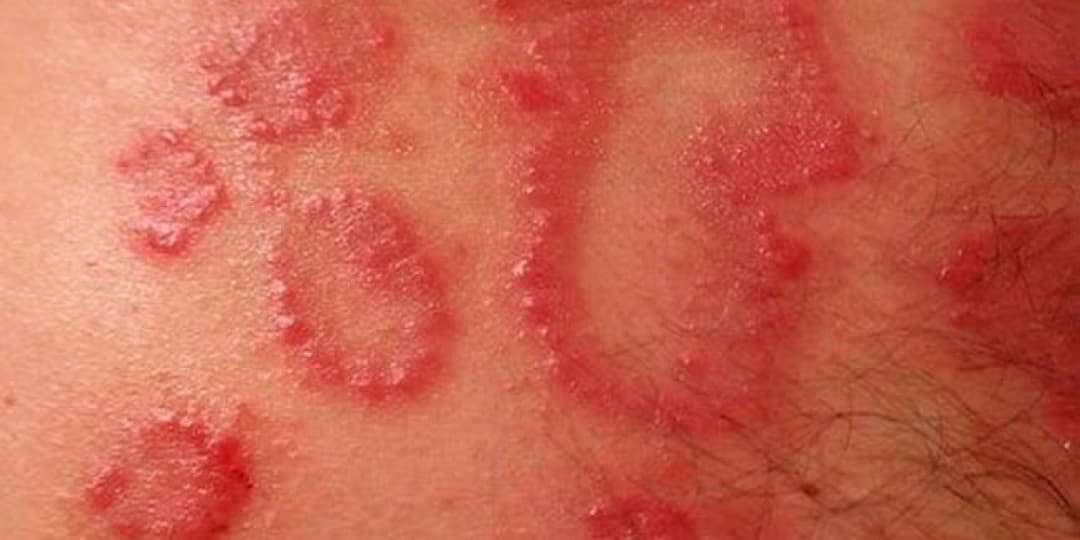 Dermatitis Atópica y de Contacto