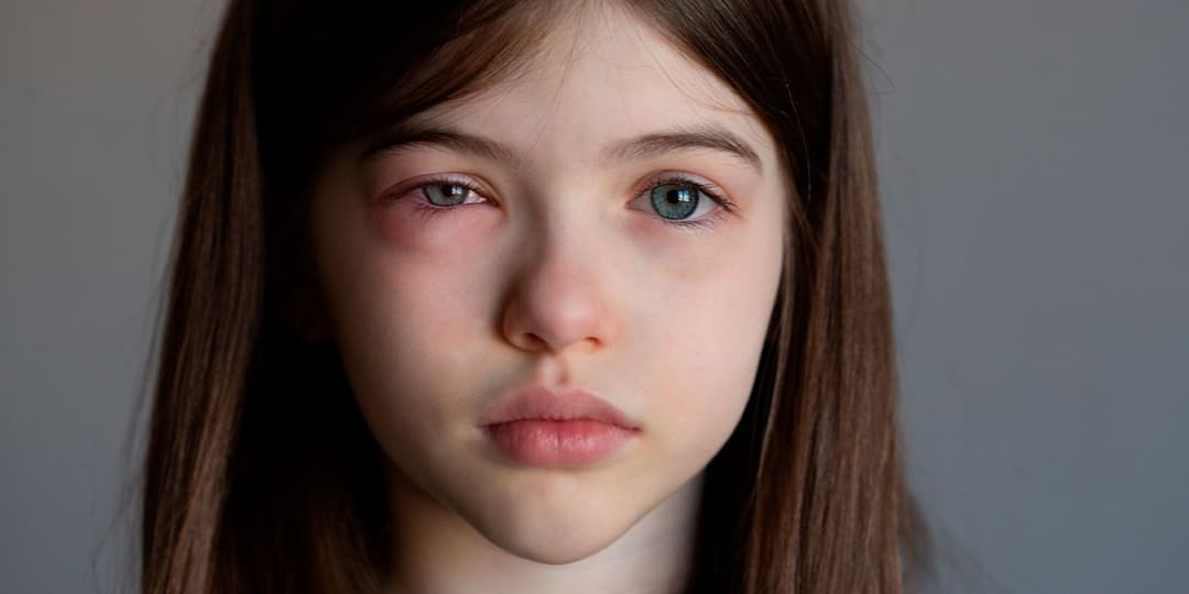 Rinoconjuntivitis Alérgica