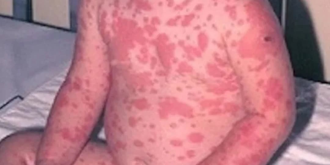 Síndrome de Stevens-Johnson