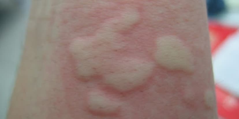Urticaria Crónica o Aguda