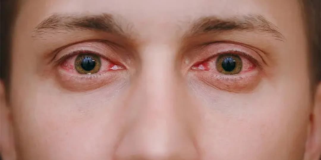 Ojos Rojos y Llorosos